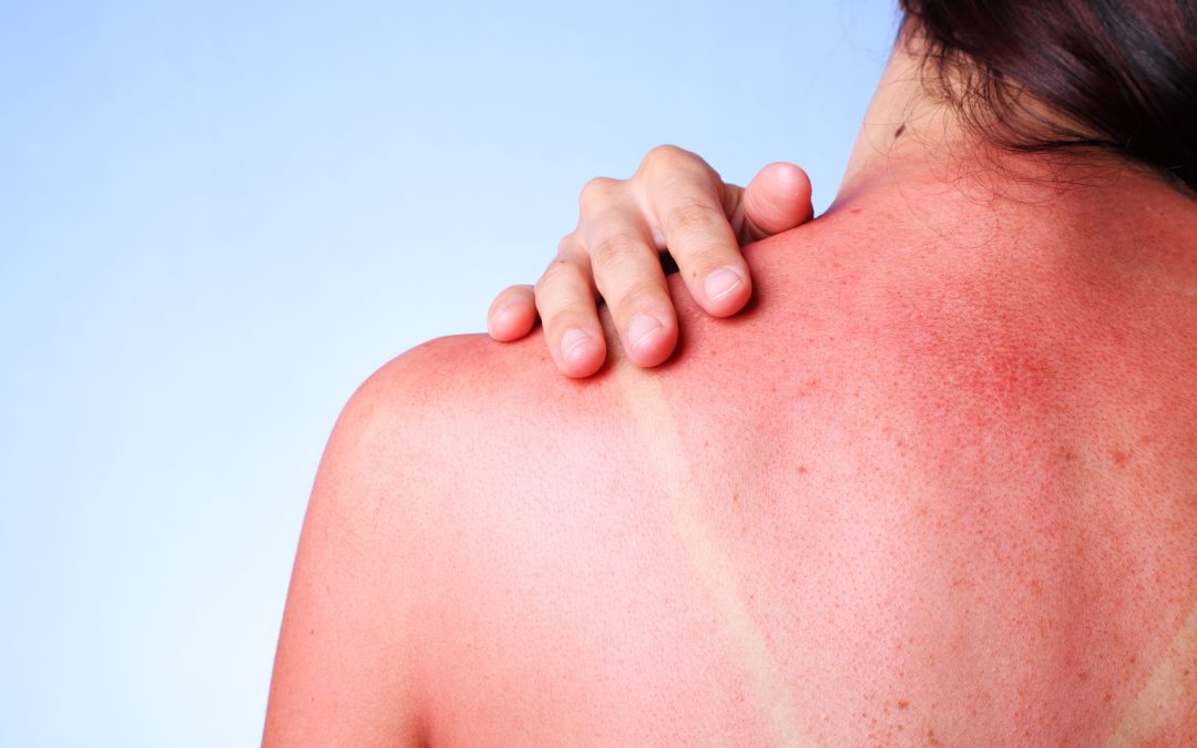 How Can I Tell If I Have Sun Poisoning?
