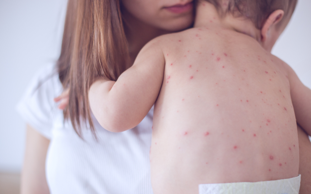 Why is there a Measles Outbreak?
